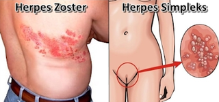 Illustration for article titled cara mengatasi penyakit herpes secara alami ampuh tanpa efek samping